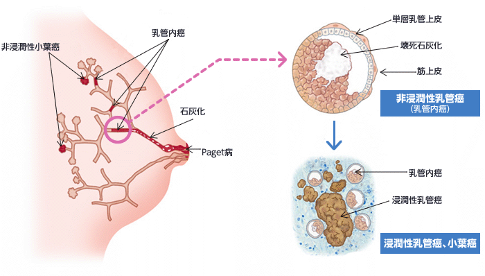 図：乳がんの発生（病理）