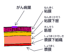 図：がん病巣