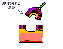 図：切り取られた病巣