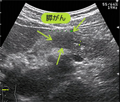 画像：超音波で観察した膵がん