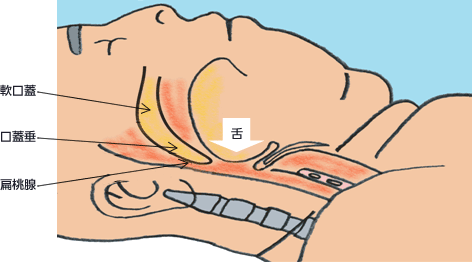 図：いびきの原理