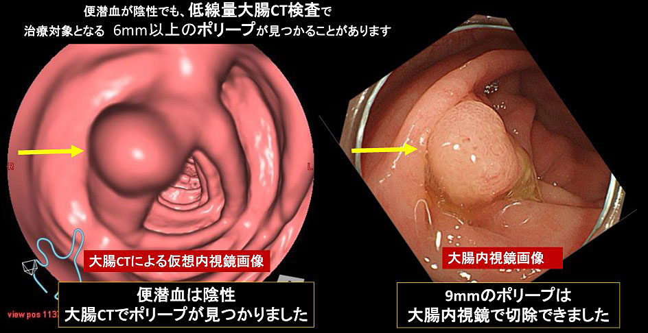 大腸CTによる仮想内視鏡画像